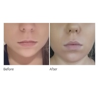 Freezeframe Lip Injection 10mL images 2